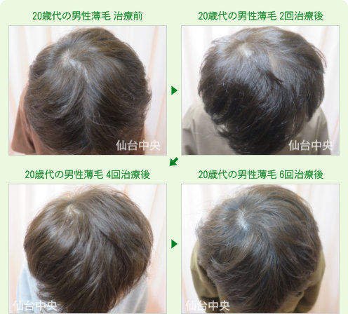20歳代の男性薄毛