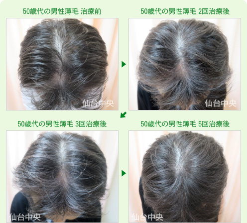 50歳代の男性薄毛