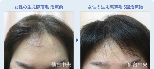 女性の生え際薄毛