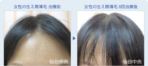 女性の生え際薄毛
