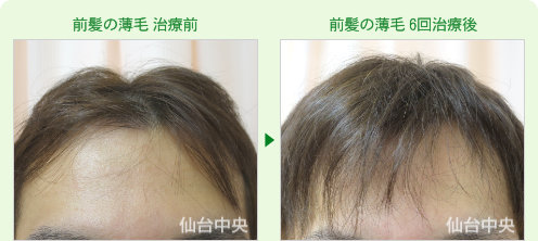 前髪が薄い