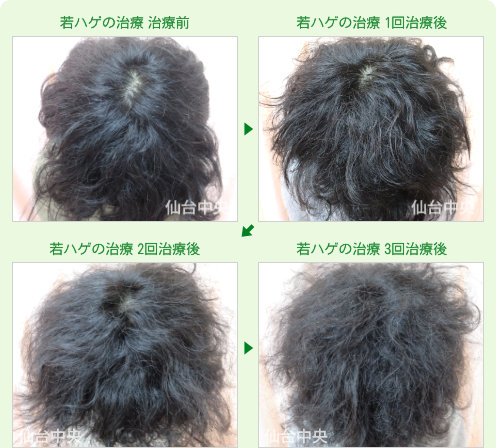 若ハゲの治療
